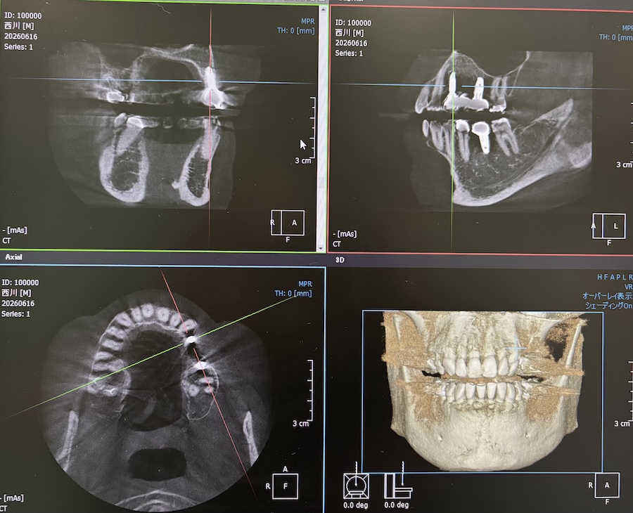 歯科用CT
